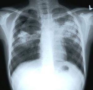World Tuberculosis Day is today, as it aims to spread awareness about the disease.<br /> .........