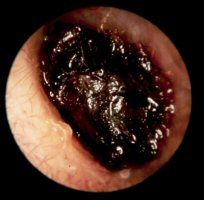 That annoying ear wax that can build up and interfeer with the ability to hear properly maybe doing more good than bad according to guidelines released by the American Academy of Otolaryngology - Head and Neck Surgery Foundation (AAO-HNSF)